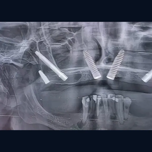 Radiografia de implantes longos da Implantodontia 4.0