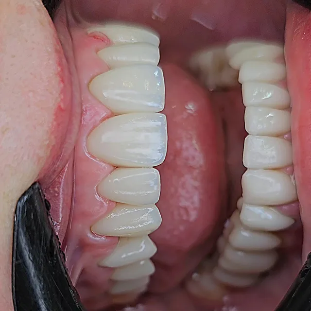 Sorriso com laminados cerâmicos