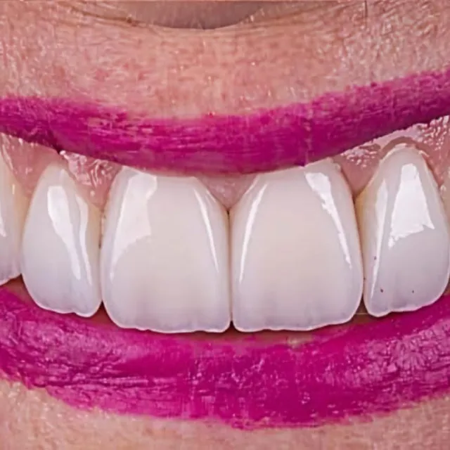 Sorriso com laminados em zircônia
