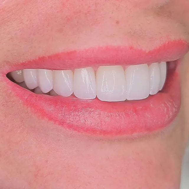 Sorriso com laminados em zircônia